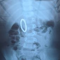 Monede, nasturi, baterii, șuruburi, insigne – sunt doar o mică parte a obiectelor înghițite de copii, care timp de 40 de ani au fost colectate de către medicii Secției Endoscopie de la Institutul Mamei și Copilului Monede, nasturi, baterii, șuruburi, insigne – sunt doar o mică parte a obiectelor înghițite de copii, care timp de 40 de ani au fost colectate de către medicii Secției Endoscopie de la Institutul Mamei și Copilului